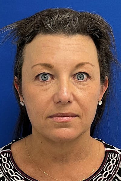 Facelift Before & After Gallery - Patient 427335 - Image 1