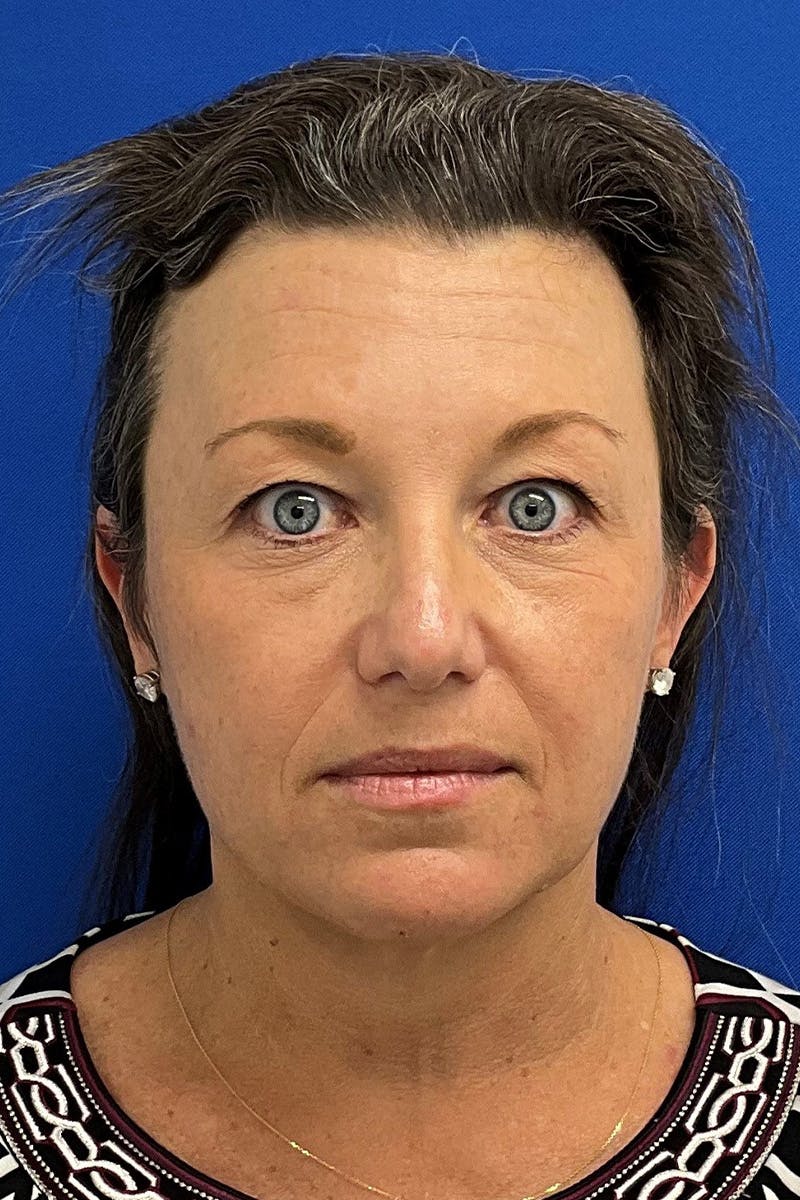 Facelift Before & After Gallery - Patient 427335 - Image 1