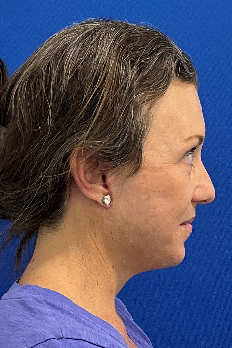 Facelift Before & After Gallery - Patient 427335 - Image 4