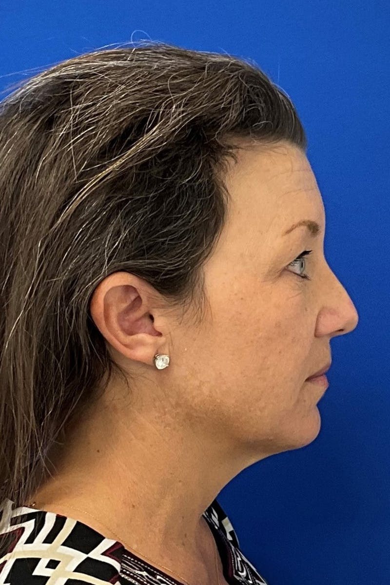 Facelift Before & After Gallery - Patient 427335 - Image 3