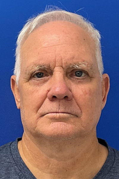 Blepharoplasty Before & After Gallery - Patient 235740 - Image 2