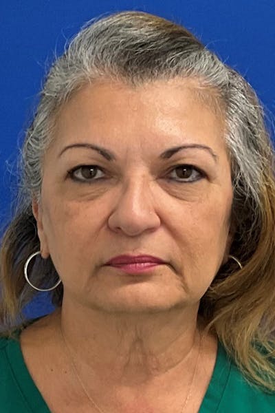 Blepharoplasty Before & After Gallery - Patient 412495 - Image 1