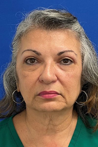 Blepharoplasty Before & After Gallery - Patient 412495 - Image 2