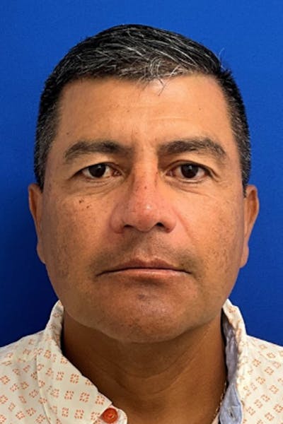 Blepharoplasty Before & After Gallery - Patient 322082 - Image 1