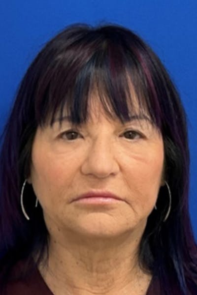 Blepharoplasty Before & After Gallery - Patient 398054 - Image 1