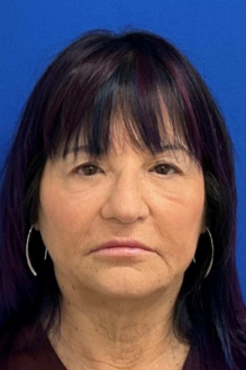 Blepharoplasty Before & After Gallery - Patient 398054 - Image 1