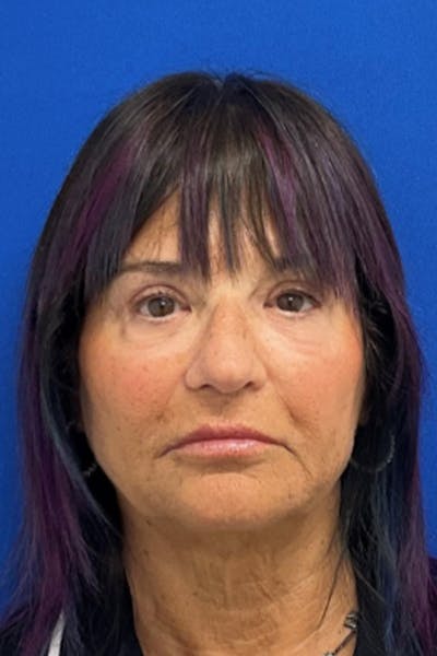 Blepharoplasty Before & After Gallery - Patient 398054 - Image 2