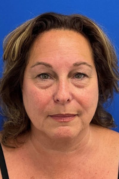 Facelift Before & After Gallery - Patient 668227 - Image 1