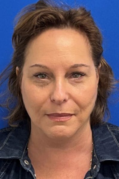 Facelift Before & After Gallery - Patient 668227 - Image 2