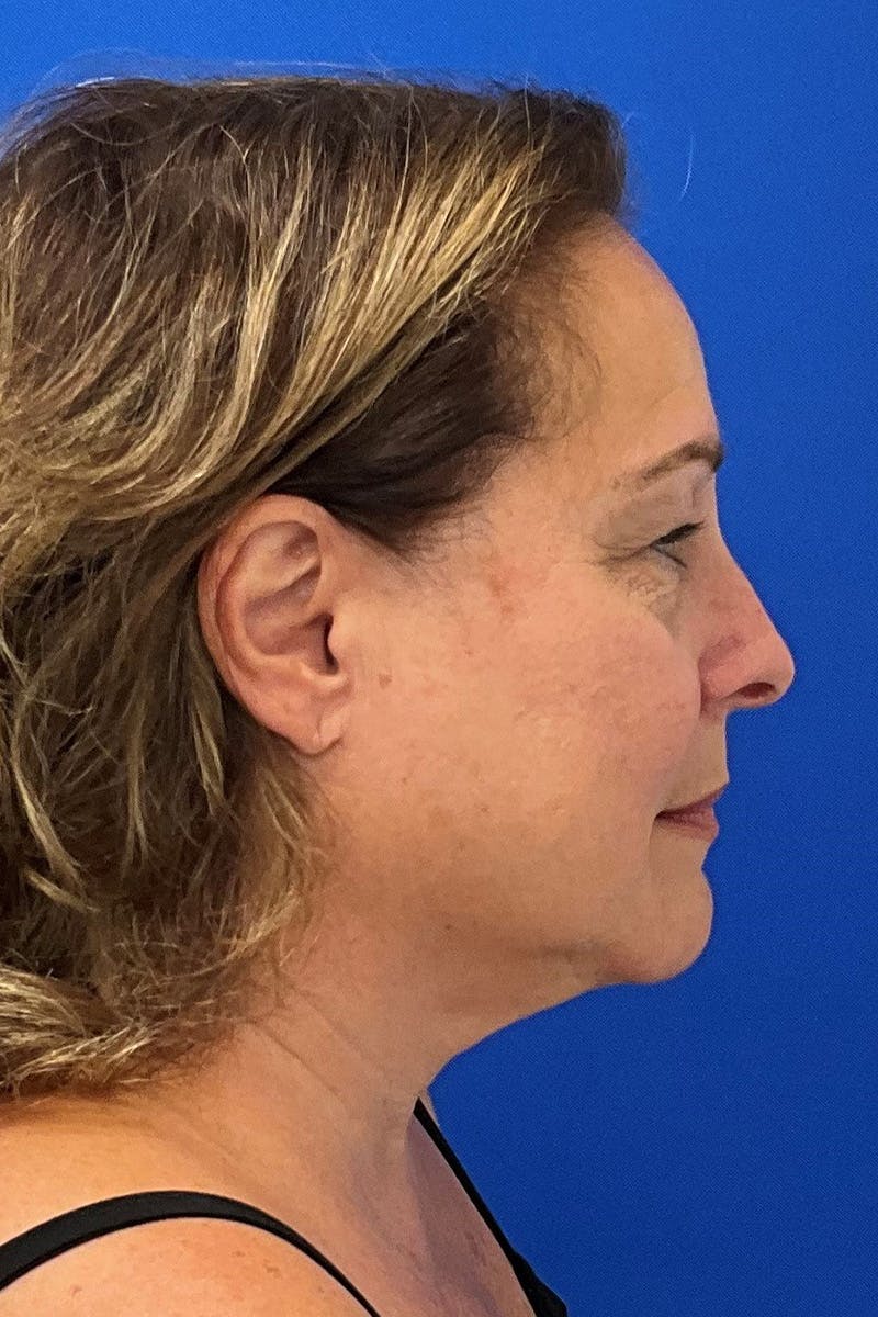 Facelift Before & After Gallery - Patient 668227 - Image 3