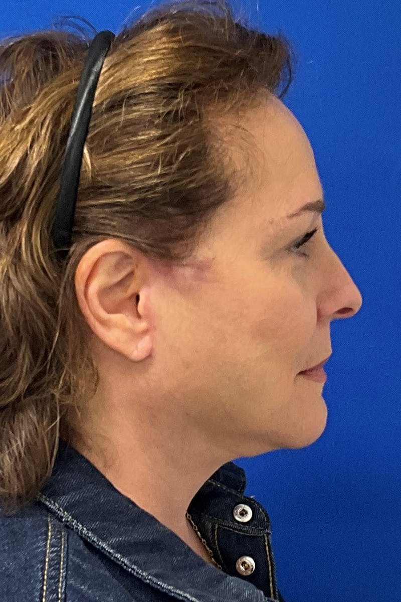 Facelift Before & After Gallery - Patient 668227 - Image 4