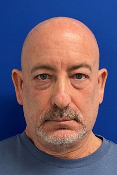Blepharoplasty Before & After Gallery - Patient 361614 - Image 1