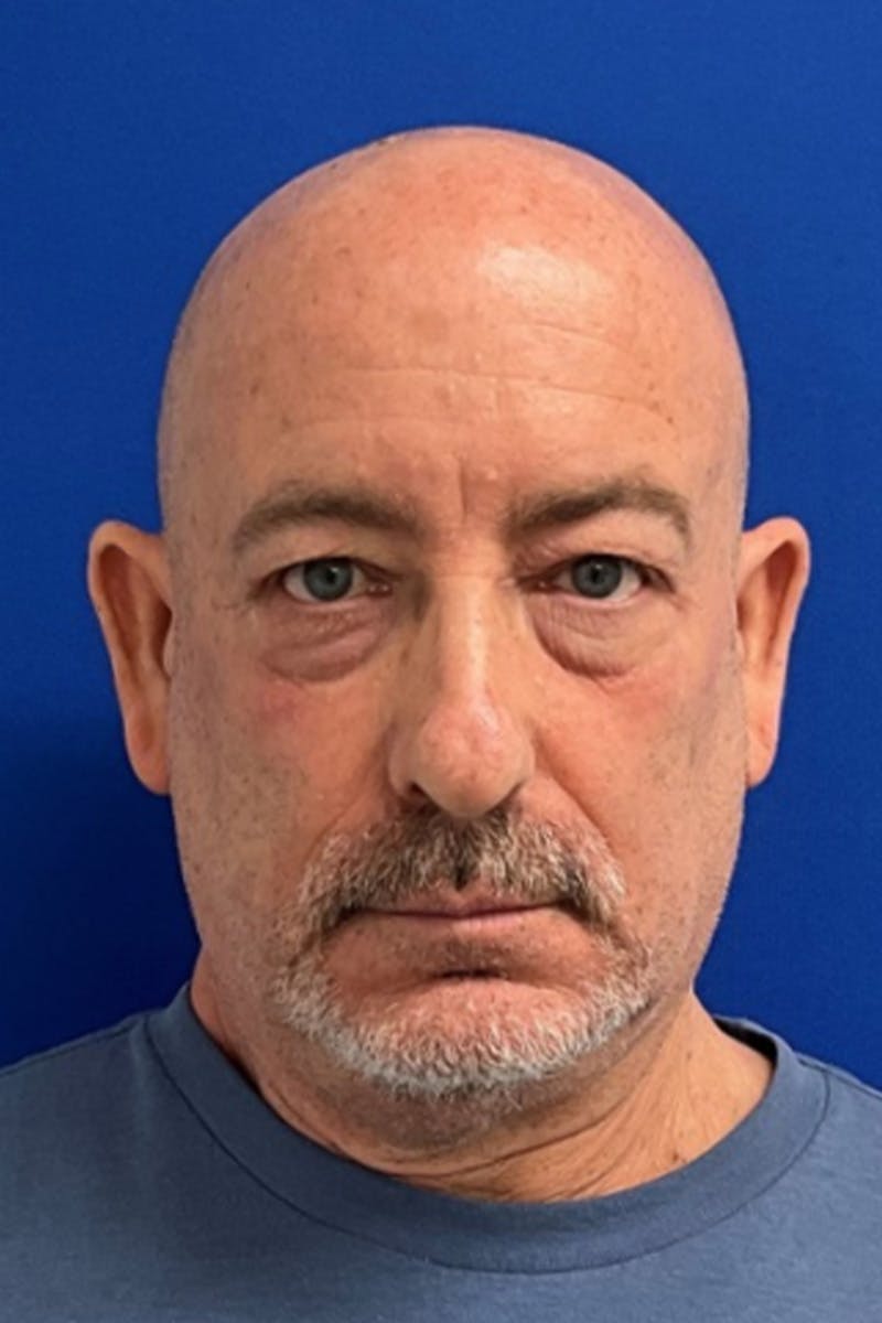 Blepharoplasty Before & After Gallery - Patient 361614 - Image 1