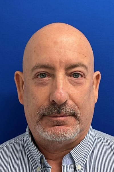 Blepharoplasty Before & After Gallery - Patient 361614 - Image 2