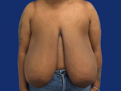 Breast Reduction Before & After Gallery - Patient 133825 - Image 1