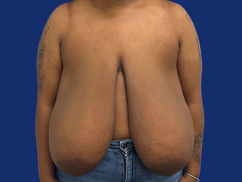 Breast Reduction Before & After Gallery - Patient 133825 - Image 1
