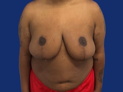 Breast Reduction Before & After Gallery - Patient 133825 - Image 2