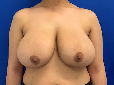 Breast Reduction Before & After Gallery - Patient 341604 - Image 1