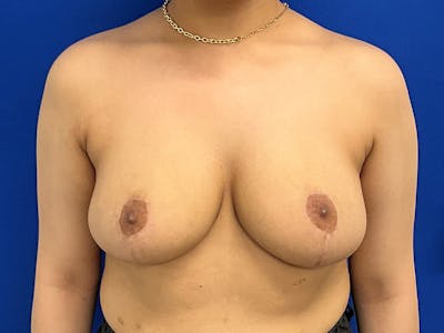 Breast Reduction Before & After Gallery - Patient 341604 - Image 2