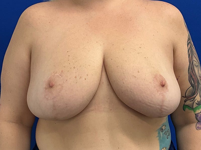 Breast Reduction Before & After Gallery - Patient 741302 - Image 2
