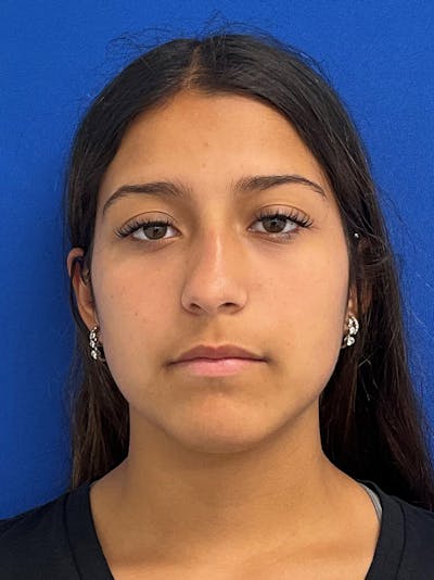 Rhinoplasty Before & After Gallery - Patient 404162 - Image 1