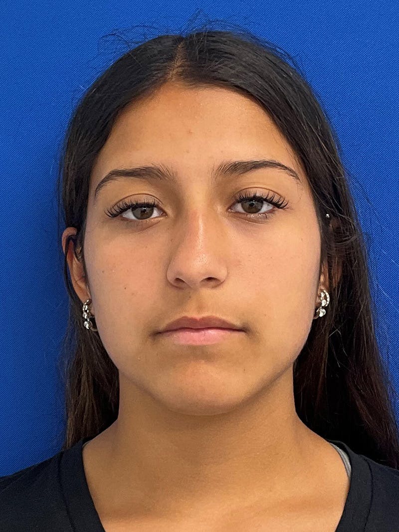 Rhinoplasty Before & After Gallery - Patient 404162 - Image 1