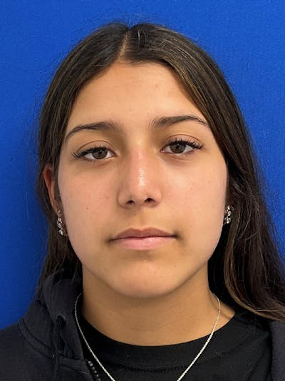 Rhinoplasty Before & After Gallery - Patient 404162 - Image 2