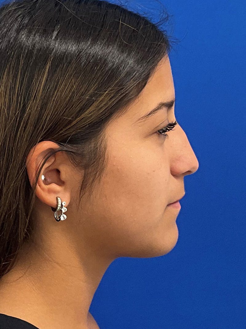 Rhinoplasty Before & After Gallery - Patient 404162 - Image 3
