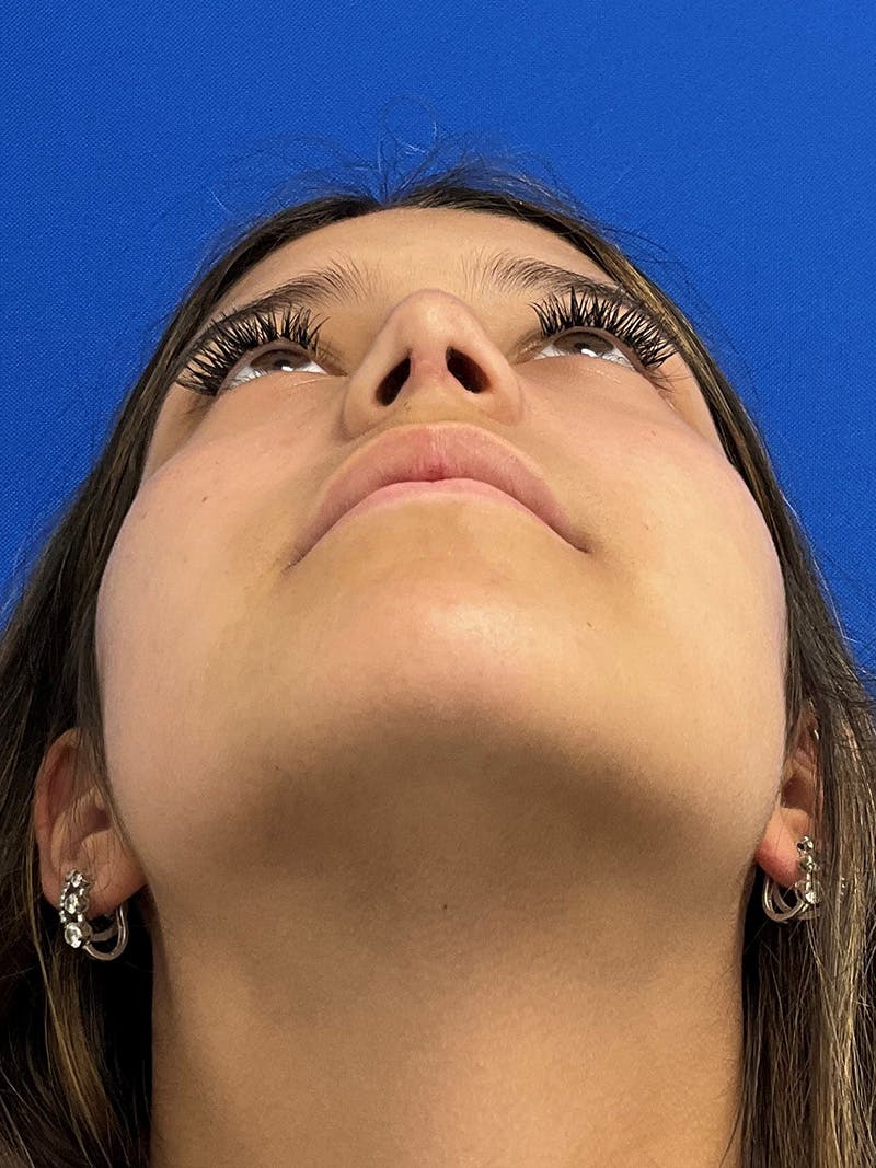 Rhinoplasty Before & After Gallery - Patient 404162 - Image 6