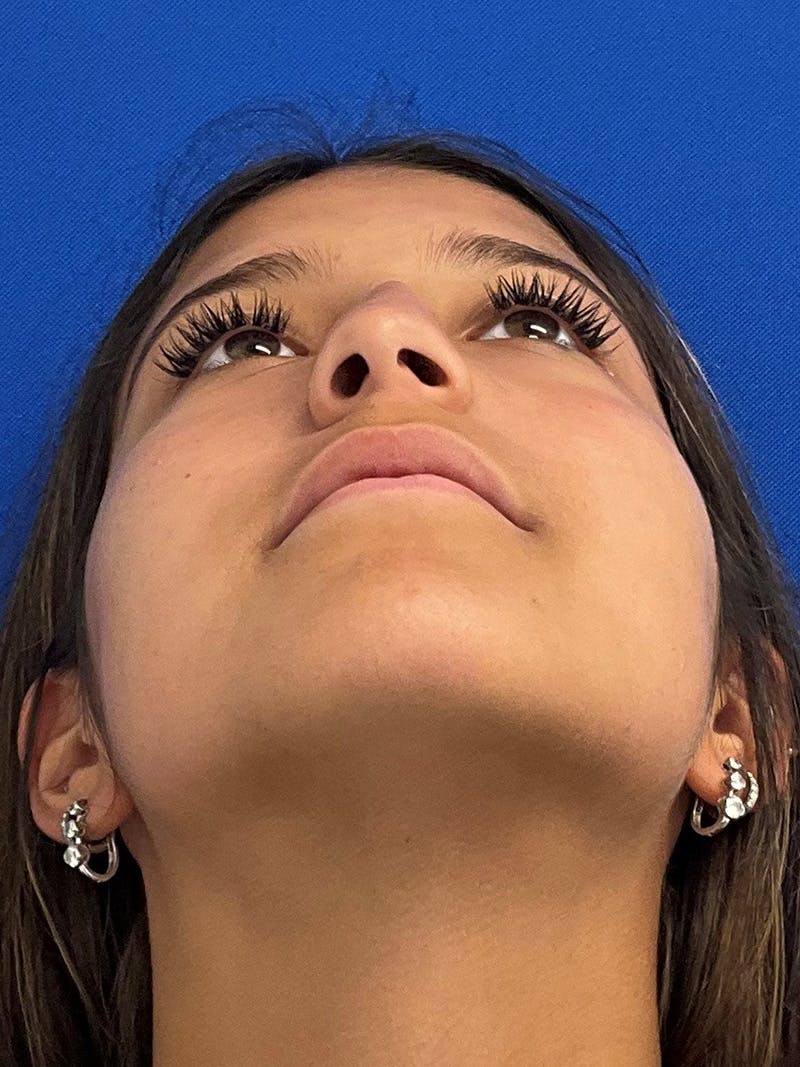 Rhinoplasty Before & After Gallery - Patient 404162 - Image 5