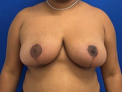 Breast Reduction Before & After Gallery - Patient 307827 - Image 2