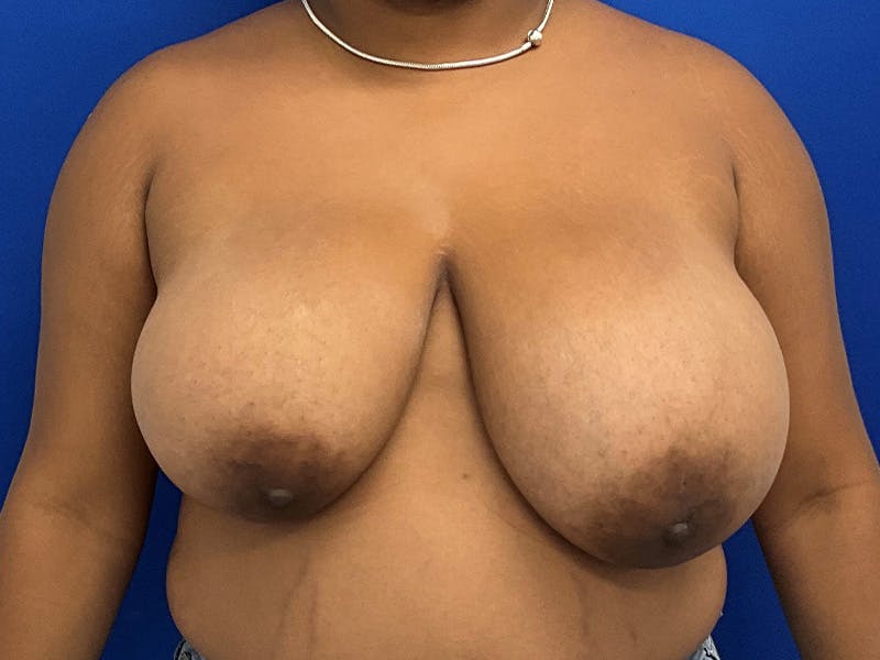 Breast Reduction Before & After Gallery - Patient 307827 - Image 1