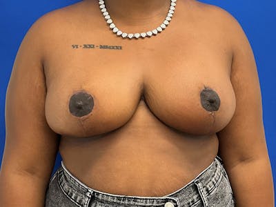 Breast Reduction Before & After Gallery - Patient 823825 - Image 2