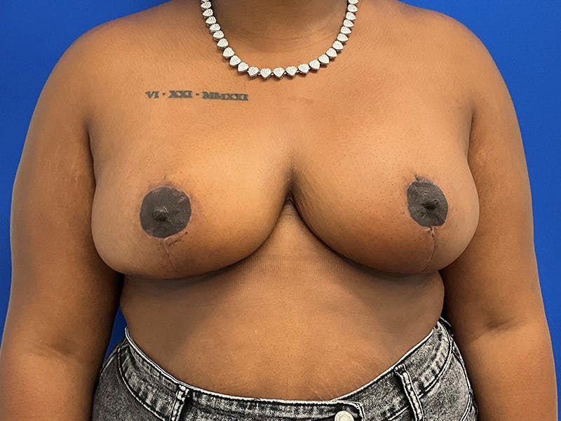 Breast Reduction Before & After Gallery - Patient 823825 - Image 2