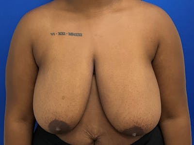 Breast Reduction Before & After Gallery - Patient 823825 - Image 1
