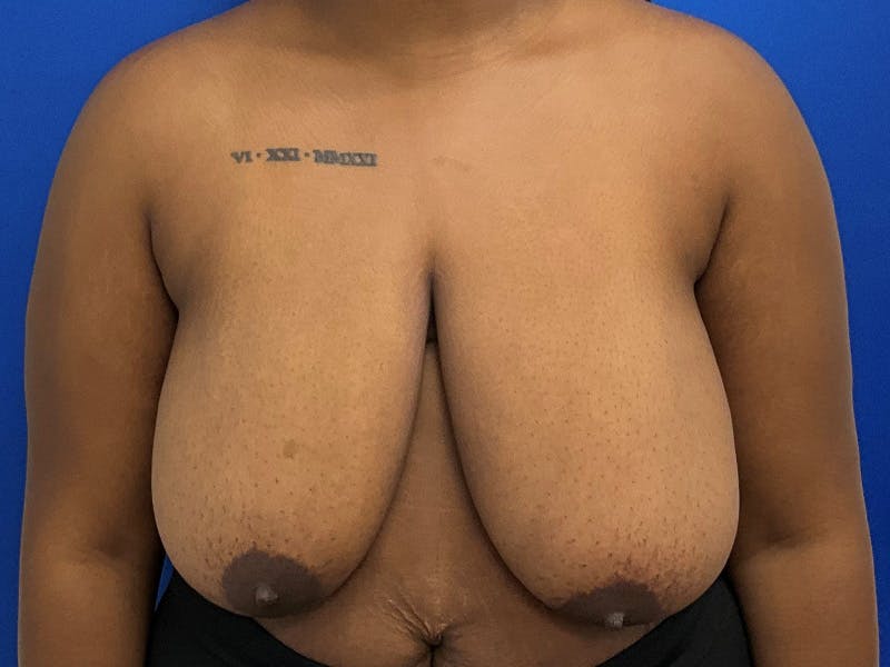 Breast Reduction Before & After Gallery - Patient 823825 - Image 1