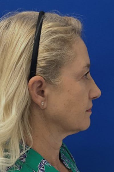 Neck Lift Before & After Gallery - Patient 123782 - Image 1