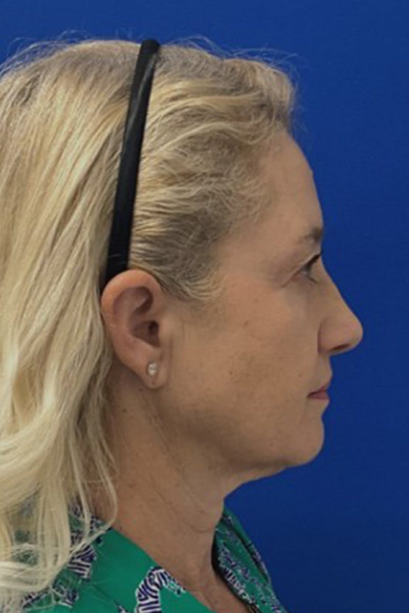 Facelift Before & After Gallery - Patient 381874 - Image 3