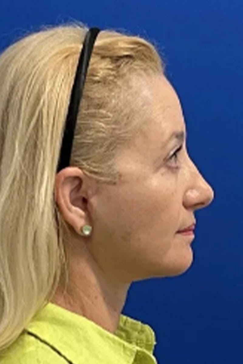 Facelift Before & After Gallery - Patient 381874 - Image 4