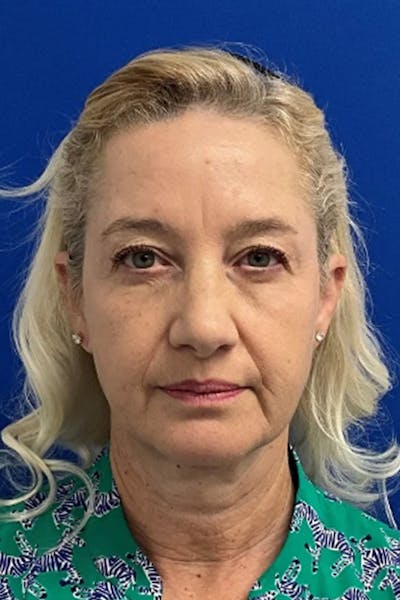 Facelift Before & After Gallery - Patient 381874 - Image 1