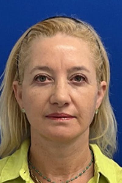 Facelift Before & After Gallery - Patient 381874 - Image 2