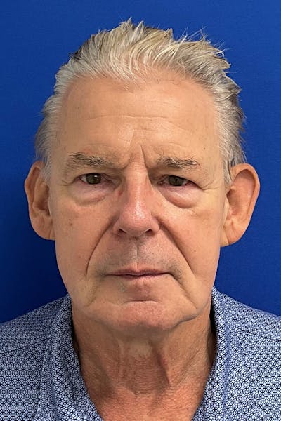 Facelift Before & After Gallery - Patient 523566 - Image 1