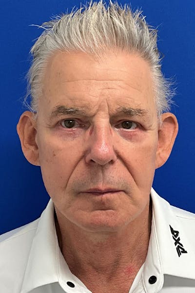 Facelift Before & After Gallery - Patient 523566 - Image 2