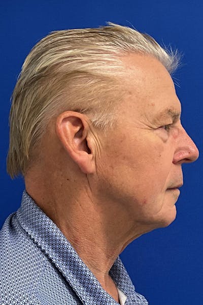 Neck Lift Before & After Gallery - Patient 413908 - Image 1