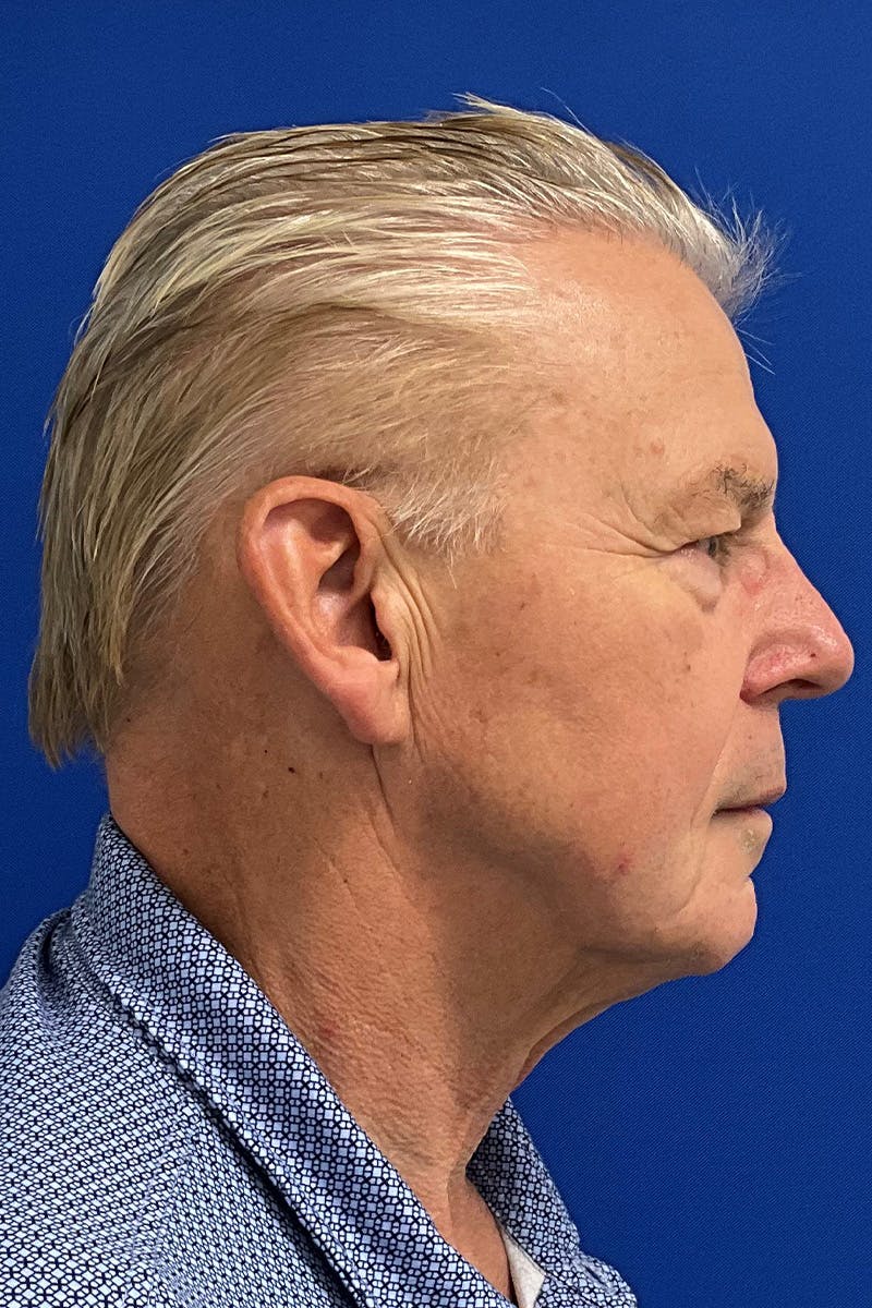 Facelift Before & After Gallery - Patient 523566 - Image 3