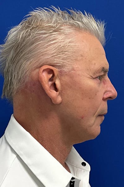 Neck Lift Before & After Gallery - Patient 413908 - Image 2