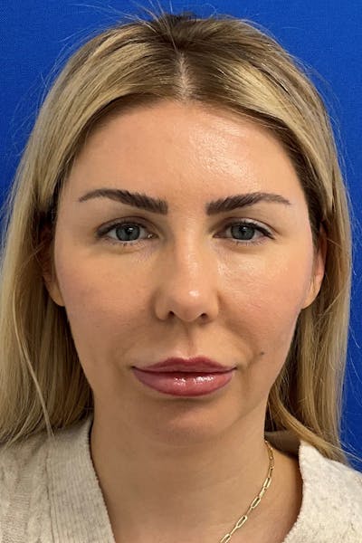 Blepharoplasty Before & After Gallery - Patient 369897 - Image 1