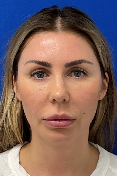 Blepharoplasty Before & After Gallery - Patient 369897 - Image 2