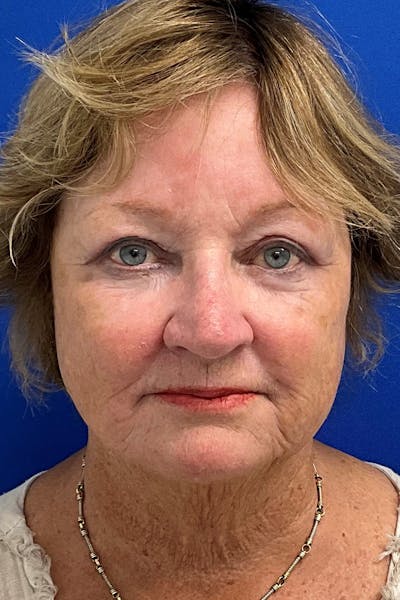 Blepharoplasty Before & After Gallery - Patient 318305 - Image 2