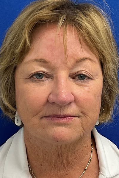 Blepharoplasty Before & After Gallery - Patient 318305 - Image 1
